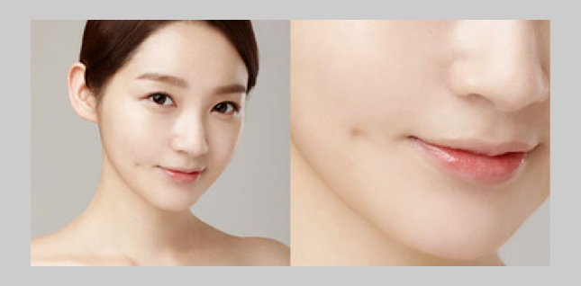 Tạo Má Lúm Đồng Tiền: Quy Trình Thực Hiện & Thời Gian Hồi Phục Chi Tiết 2 image 126