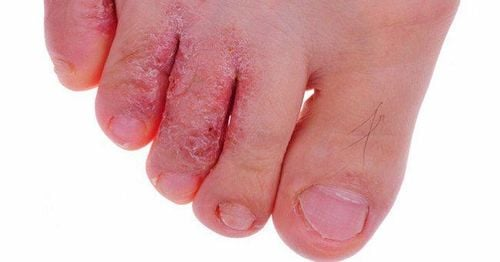 Nấm Da Chân: Nhận Biết, Nguyên Nhân, Điều Trị và Phòng Ngừa Hiệu Quả 4 image 128