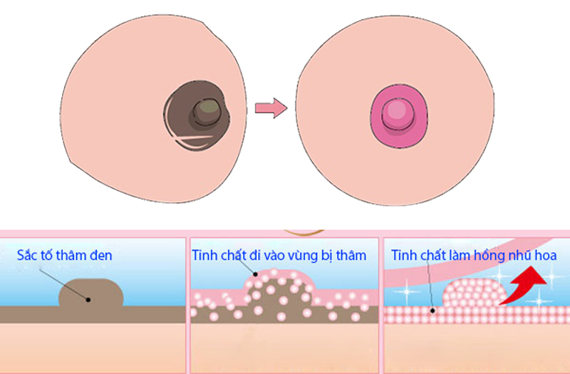 Làm Hồng Nhũ Hoa và Vùng Kín: Các Phương Pháp Hiệu Quả, An Toàn Nhất Hiện Nay 4 image 132
