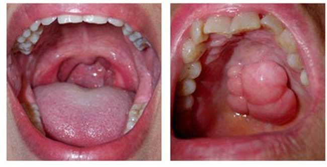 Ung thư sàn miệng: Triệu chứng, nguyên nhân và hướng điều trị 2 image 136