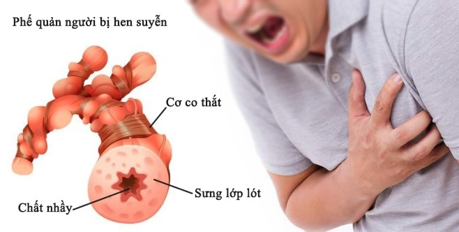 Cơn Hen Phế Quản Cấp Là Gì? Triệu Chứng, Nguyên Nhân Và Cách Điều Trị 2 image 137