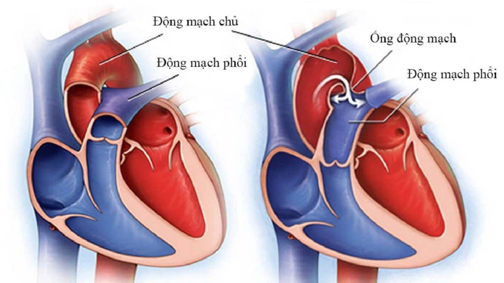 Hội chứng Shone: Khám phá nguyên nhân, triệu chứng và phương pháp điều trị hiệu quả 2 image 14