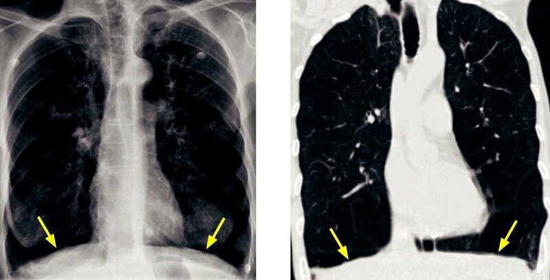 Khí phế thũng: Triệu chứng, nguyên nhân và cách điều trị hiệu quả 2 image 143
