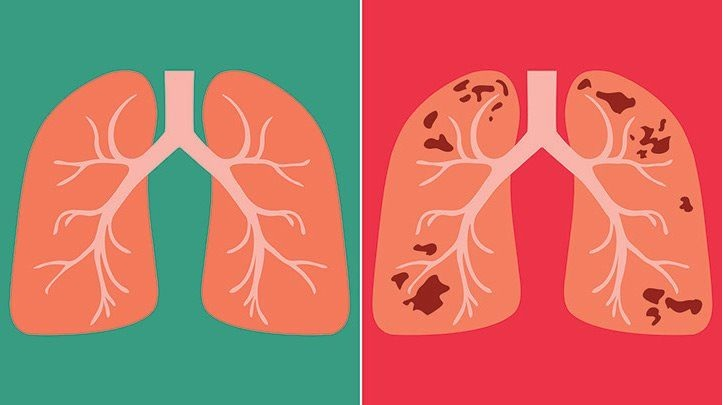 Lao tiềm ẩn: Căn bệnh thầm lặng nhưng không thể xem thường 2 image 151