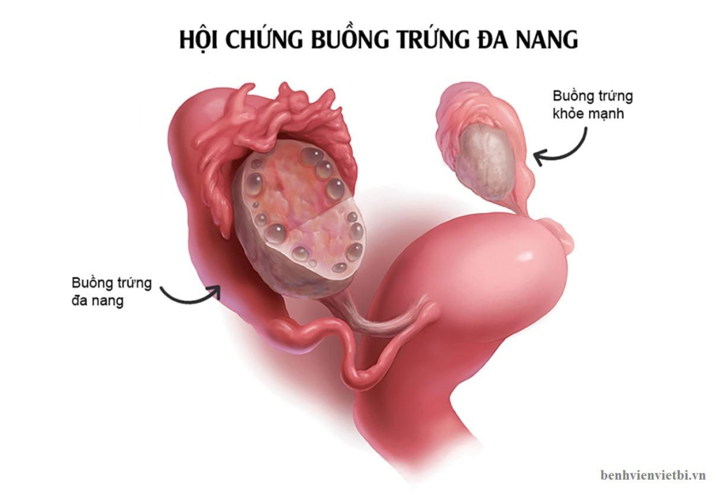 Hội Chứng Buồng Trứng Đa Nang (PCOS): Nguyên Nhân, Triệu Chứng và Cách Điều Trị Hiệu Quả 2 image 17