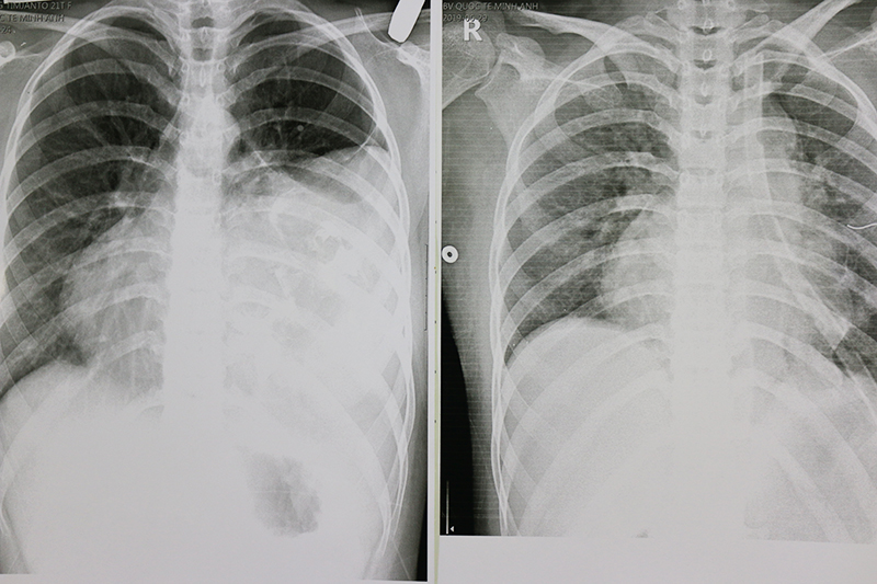 U quái trung thất: Nguyên nhân, triệu chứng, chẩn đoán và điều trị hiệu quả 2 image 171