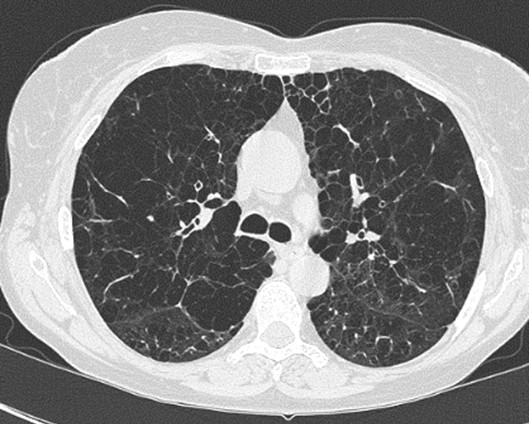 Khí phế thũng cạnh vách: Nguyên nhân, triệu chứng và cách điều trị hiệu quả 2 image 176
