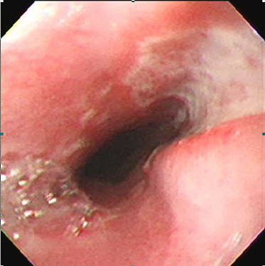 Nhiễm nấm Candida thực quản: Nguyên nhân, triệu chứng và cách điều trị hiệu quả 2 image 179