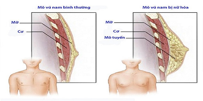 Phì đại tuyến vú ở nam giới: Nguyên nhân, chẩn đoán và hướng điều trị hiệu quả 2 image 182