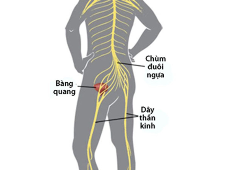 Hội chứng chùm đuôi ngựa: Dấu hiệu, Nguyên nhân và Giải pháp điều trị kịp thời 2 image 217