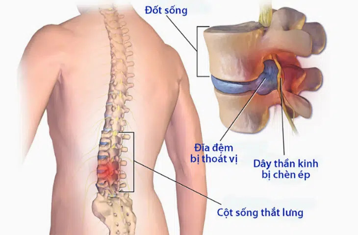 Thoát Vị Đĩa Đệm (Gây Chèn Ép Dây Thần Kinh): Những Điều Cần Biết 2 image 218