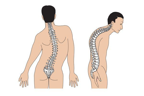 Loạn dưỡng cơ trương lực: Bệnh di truyền ảnh hưởng đa cơ quan 2 image 222