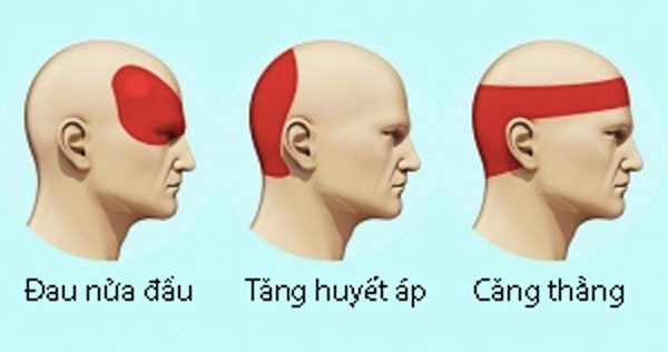 Đau Đầu Do Căng Thẳng: Nguyên Nhân, Triệu Chứng và Phương Pháp Điều Trị Hiệu Quả 2 image 223
