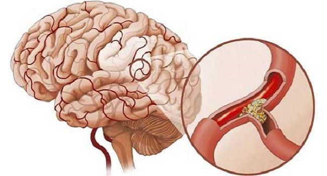 Rối loạn ngôn ngữ do tổn thương thần kinh: Hiểu đúng để can thiệp kịp thời 2 image 246