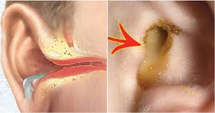 Chảy Mủ Tai: Nguyên Nhân, Triệu Chứng và Cách Điều Trị Hiệu Quả 2 image 248