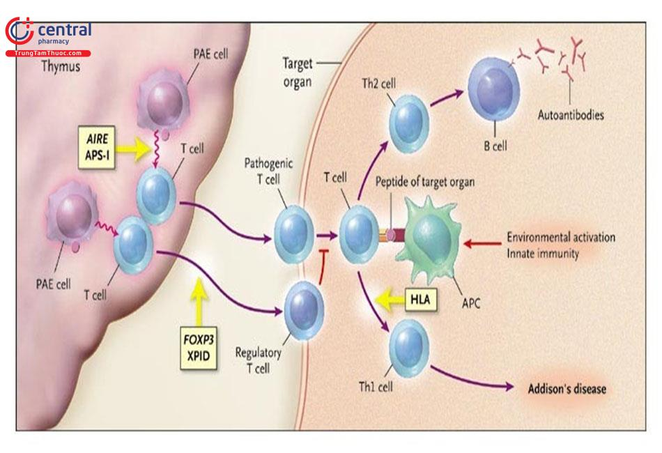 Hội chứng tự miễn đa tuyến type 1 (APS-1): Tổng quan, nguyên nhân và triệu chứng điển hình 3 image 28