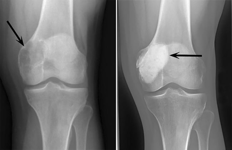 U tế bào khổng lồ (Giant Cell Tumor – GCT): Tổng quan, nguyên nhân và điều trị 3 image 3