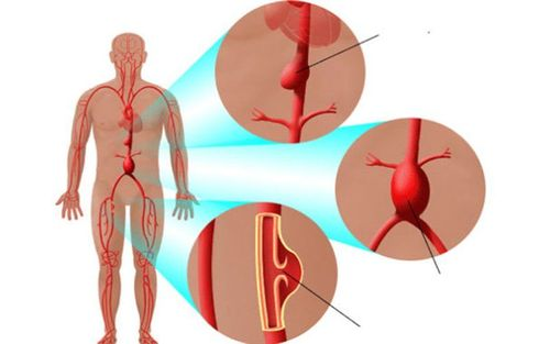 Giả phình động mạch sau chọc mạch máu: Nguyên nhân, chẩn đoán và điều trị hiệu quả 3 image 31