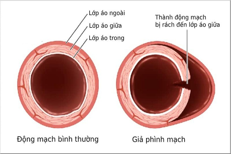 Giả phình động mạch sau chọc mạch máu: Nguyên nhân, chẩn đoán và điều trị hiệu quả 4 image 32