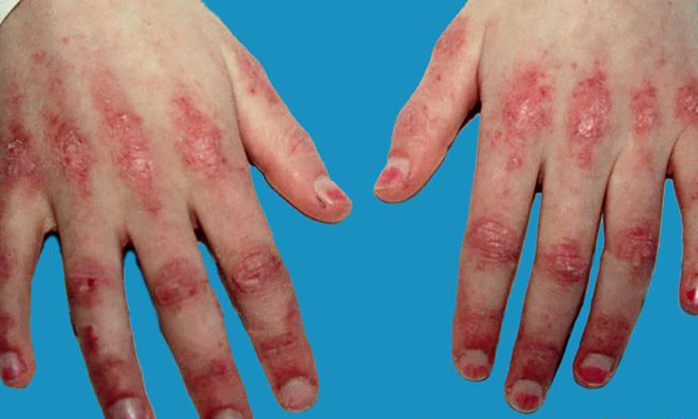 Viêm đa cơ và viêm da cơ: Mối nguy hiểm thầm lặng với trái tim 2 image 39
