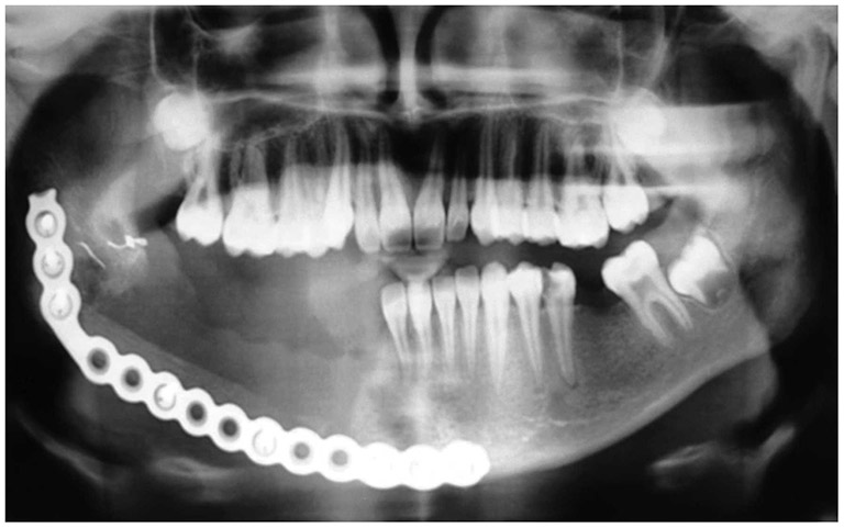 U tế bào khổng lồ (Giant Cell Tumor – GCT): Tổng quan, nguyên nhân và điều trị 4 image 4