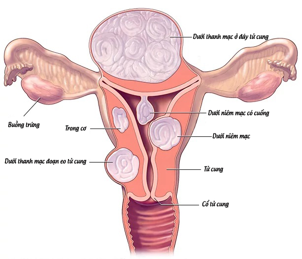 U xơ tử cung: Hiểu đúng để điều trị hiệu quả và bảo vệ sức khỏe sinh sản 3 image 54