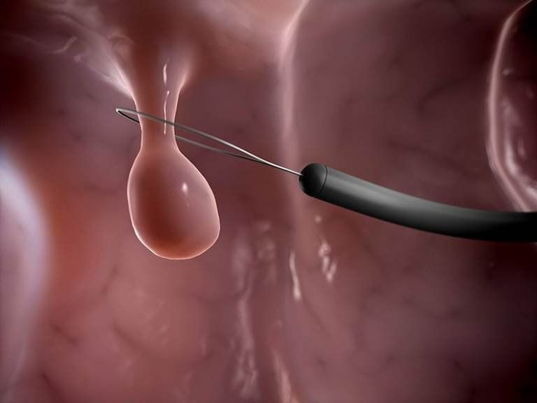 Polyp nội mạc tử cung: Những điều cần biết để bảo vệ sức khỏe sinh sản 4 image 57