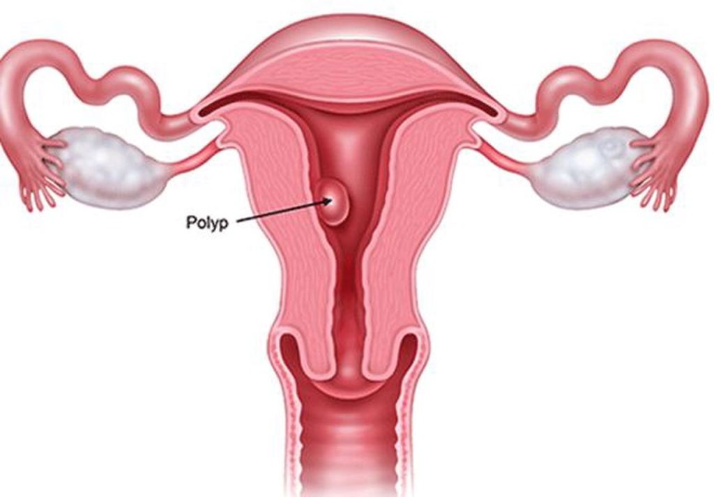 Polyp nội mạc tử cung: Những điều cần biết để bảo vệ sức khỏe sinh sản 3 image 58