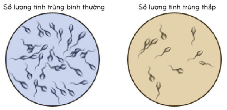 Tinh Trùng Ít (Oligospermia): Nguyên Nhân, Triệu Chứng Và Hướng Điều Trị Hiệu Quả 4 image 60