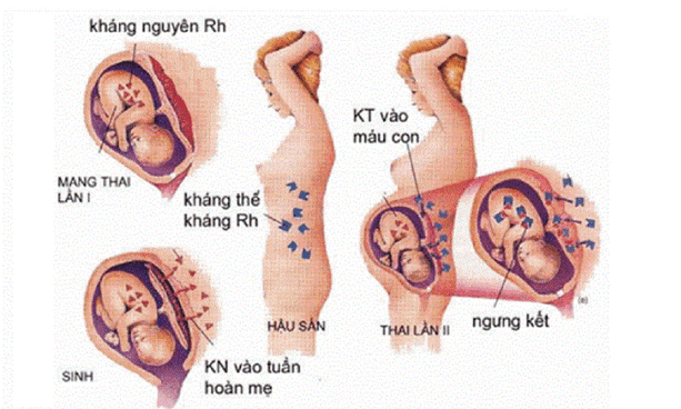 Bất Đồng Nhóm Máu Mẹ Con (Rh, ABO): Nguy Cơ Tiềm Ẩn Trong Thai Kỳ 2 image 68