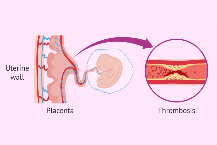 Sảy thai do hội chứng Antiphospholipid: Nguyên nhân, triệu chứng và điều trị 2 image 72