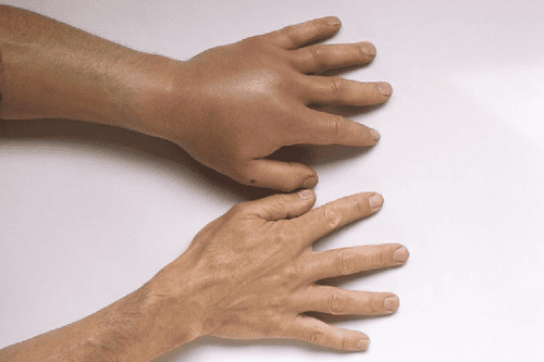 Phù mạch di truyền: Bệnh lý hiếm gặp nhưng không thể xem nhẹ 2 image 77
