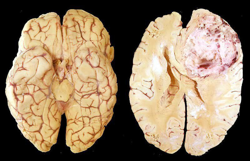 U nguyên bào thần kinh (Neuroblastoma): Toàn cảnh về căn bệnh ung thư phổ biến ở trẻ nhỏ 2 image 8