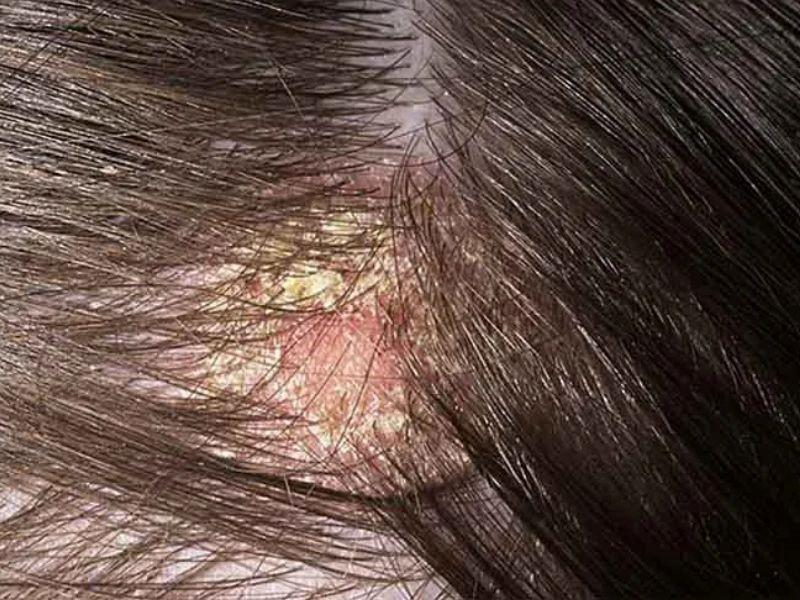 Ung Thư Da Đầu: Nguyên Nhân, Dấu Hiệu Và Cách Phòng Ngừa Hiệu Quả 2 image 9