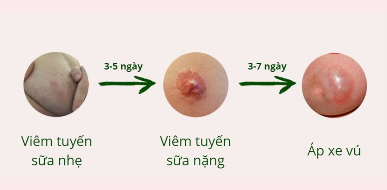 Viêm tuyến vú có nguy hiểm không