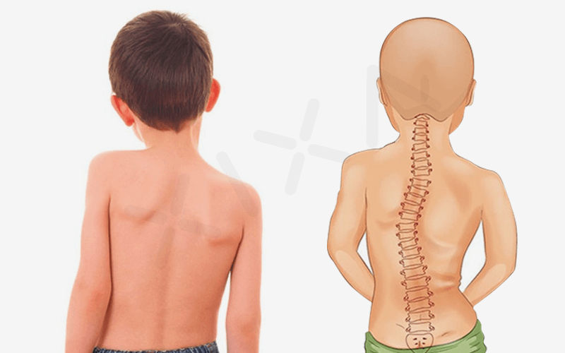Cong Vẹo Cột Sống: Nguyên Nhân, Triệu Chứng và Hướng Điều Trị Toàn Diện 2 image