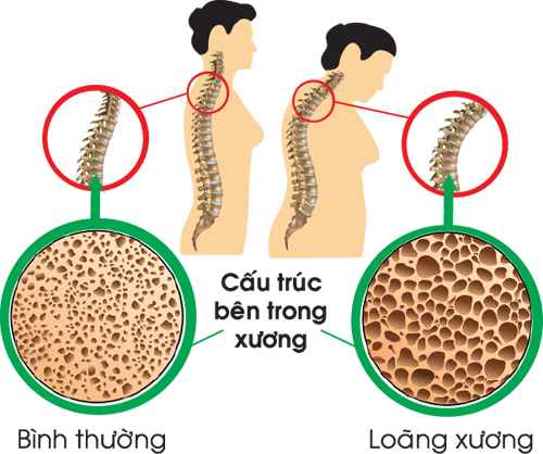 Loãng Xương Sau Mãn Kinh: Hiểu Rõ Nguyên Nhân, Triệu Chứng và Hướng Điều Trị Hiệu Quả 8 Đo mật độ xương ở phụ nữ sau mãn kinh