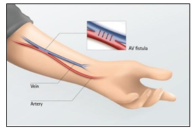 Hình ảnh mô phỏng dò động-tĩnh mạch