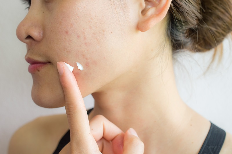 Cơ chế Acid Salicylic làm sạch lỗ chân lông