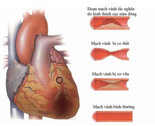 Hình ảnh minh họa co thắt động mạch vành