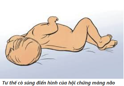 Triệu chứng đau cứng cổ gáy