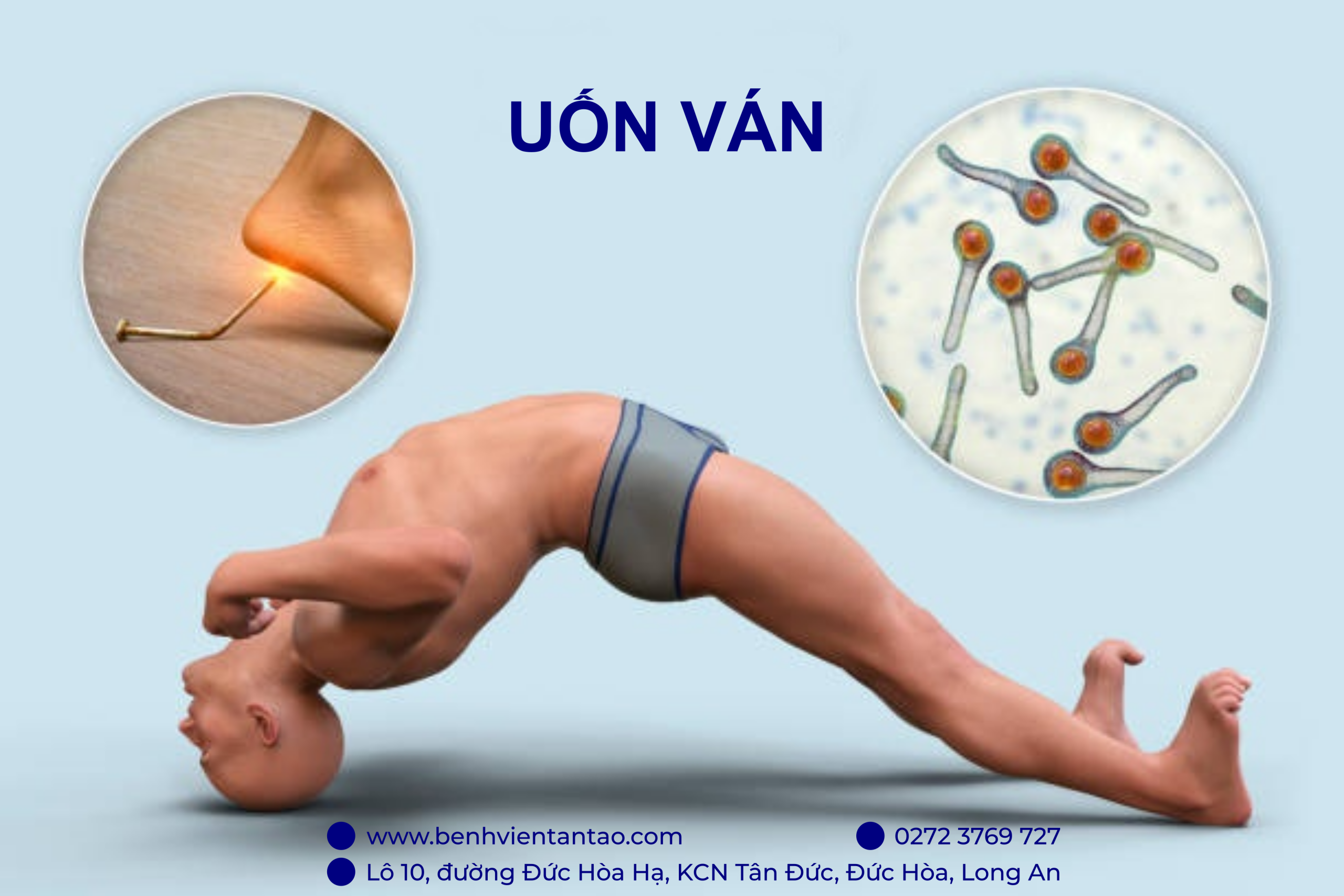 Triệu chứng uốn ván cục bộ