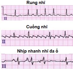 điện tâm đồ rung nhĩ