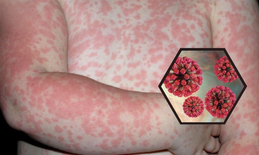 Hướng dẫn chăm sóc trẻ bị sốt phát ban