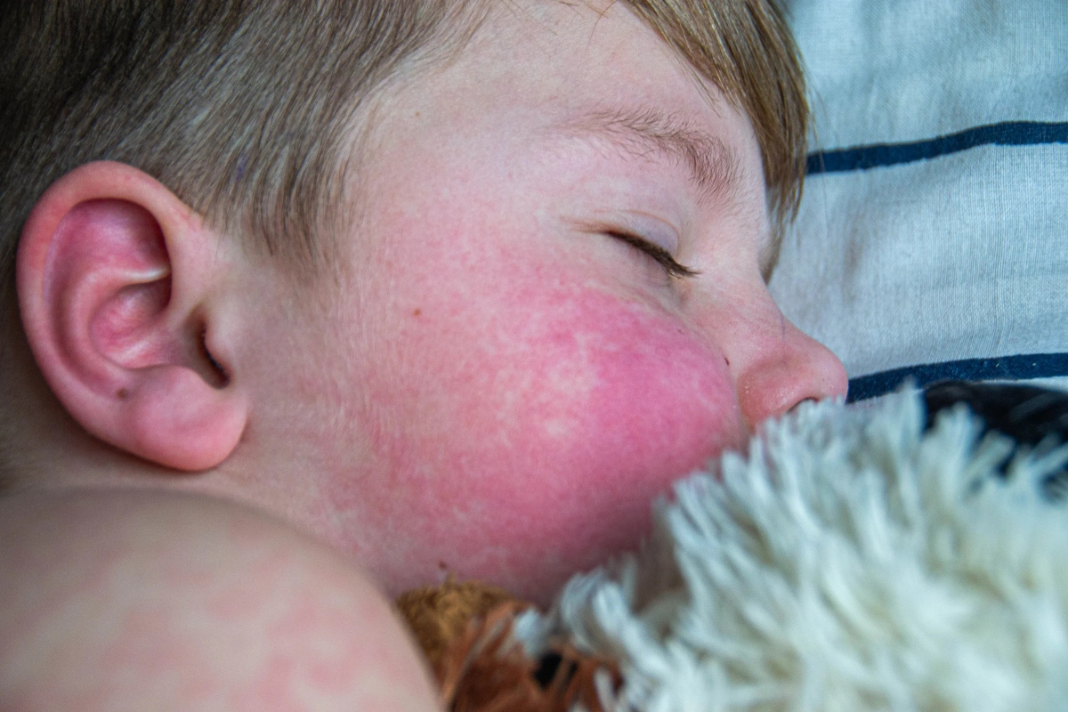 Nhiễm Parvovirus B19: Triệu chứng, nguyên nhân và cách điều trị 7 Trẻ em bị phát ban do Parvovirus B19
