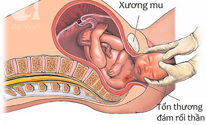 Kẹt vai khi sinh (Distoci do vai): Tình trạng nguy hiểm cần biết để bảo vệ mẹ và bé 8 Kẹt vai trong sinh thường