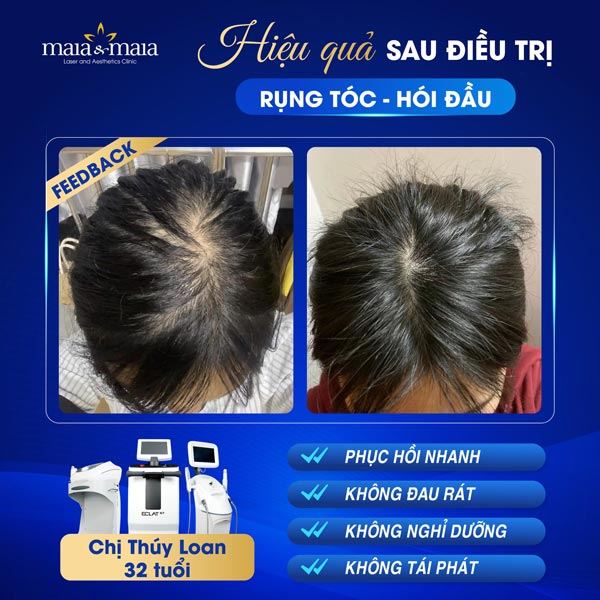 Sau khi cấy tóc