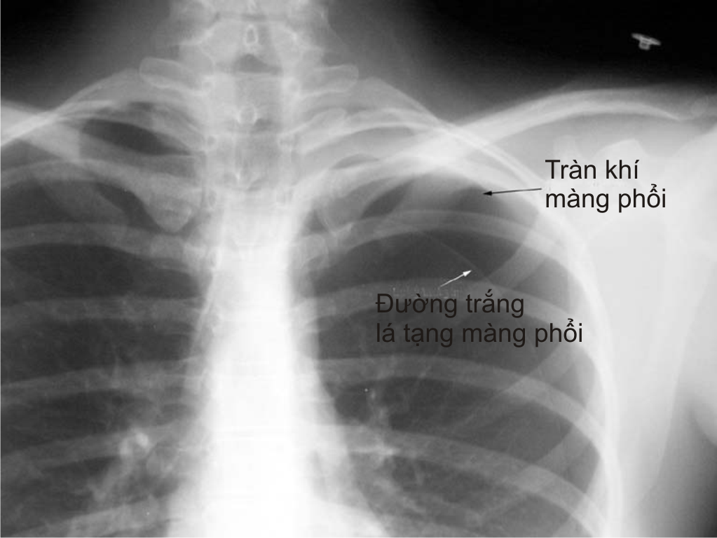 tràn khí màng phổi là gì