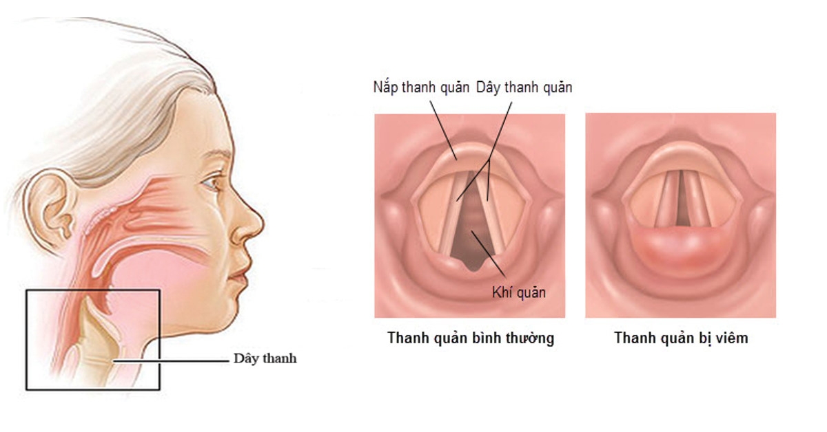 Người bị khàn giọng quấn khăn ấm