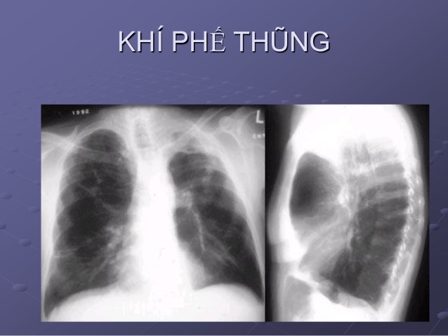 khí phế thũng thùy bẩm sinh